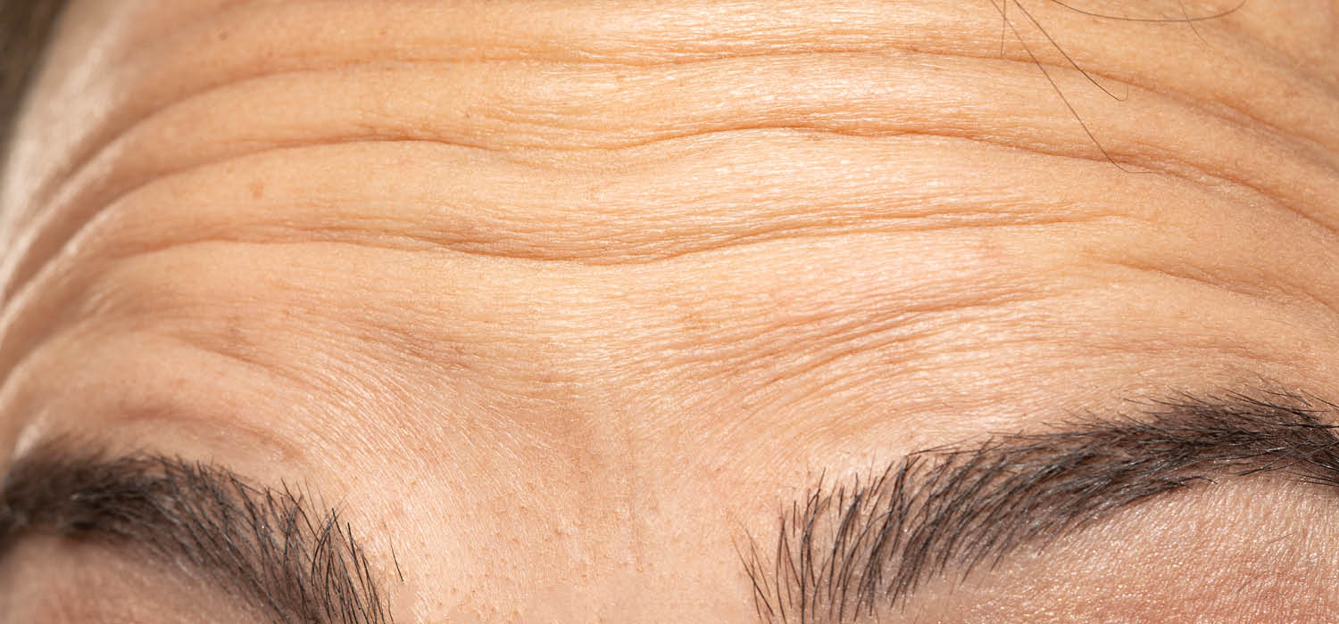 Quem precisa de botox preventivo?